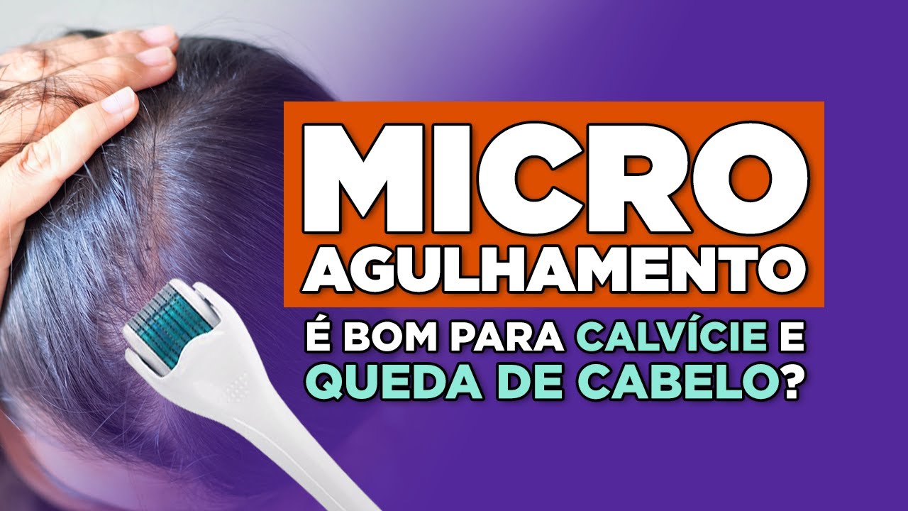 Microagulhamento é bom para calvície e queda de cabelo?