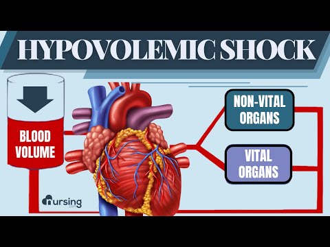 Hypovolemic Shock | Patho and Treatment- Nursing