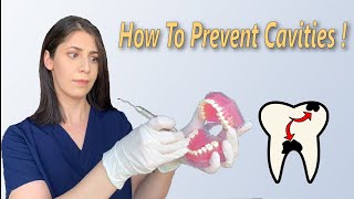 What causes cavities? | How to prevent cavities!
