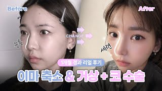 [리얼모델 VLOG] 뭐 했나? 예뻐졌는데✨｜이마 축소&거상+코 수술 1달 경과 리얼 후기 #일퍼센트성형외과