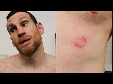 Kash Ali Disqualified For Biting David Price During Fight