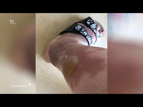 Gefährliche Bisse: Kriebelmücke breitet sich aus | maintower