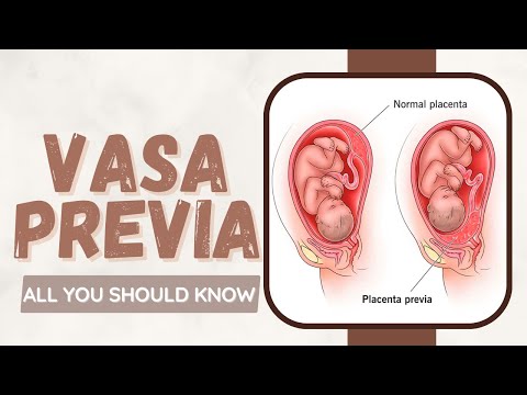 Vasa previa: Everything You Need To Know