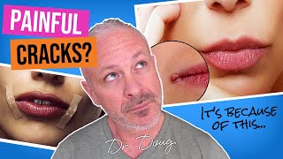 Why do I have CRACKED MOUTH CORNERS? (Angular Cheilitis)   |   Dr. Doug Willen