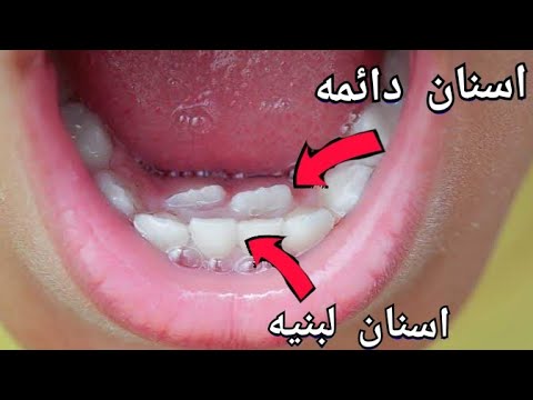 , title : 'حل مشكله ظهور الاسنان الدائمه خلف الاسنان اللبنيه في الاطفال'