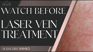 What To Expect - Excel V Laser Vein Treatment | Instantly Remove Spider Veins!