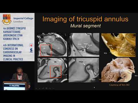 F. Faletra  | Anatomy of the Tricuspid Valve