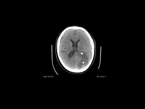 image-What are the causes of cerebral edema?