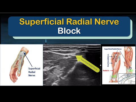 SUPERFICIAL RADIAL NERVE Block - a "How-To" Guide (for Motor-Sparing Wrist Blocks)