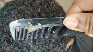 Clumps of Dandruff | Muted Video