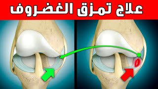 علاج مضمون ١٠٠ تمزق غضروف الركبه الهلالي انسى الم المشي والدرج السجود قفل الركبه
