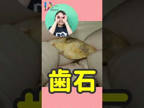 RIM-24 歯石について詳しく解説