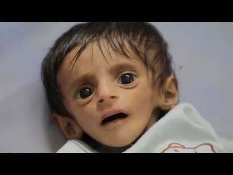 قلق من سوء التغذية طويل الأمد في اليمن