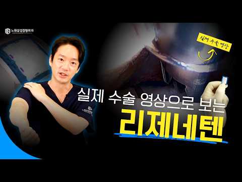 리제네텐｜실제 수술 영상을 보며 설명드립니다