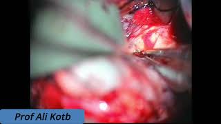 Download Lagu Craniopharyngioma Excision from the Third Ventricle Thumbnail
