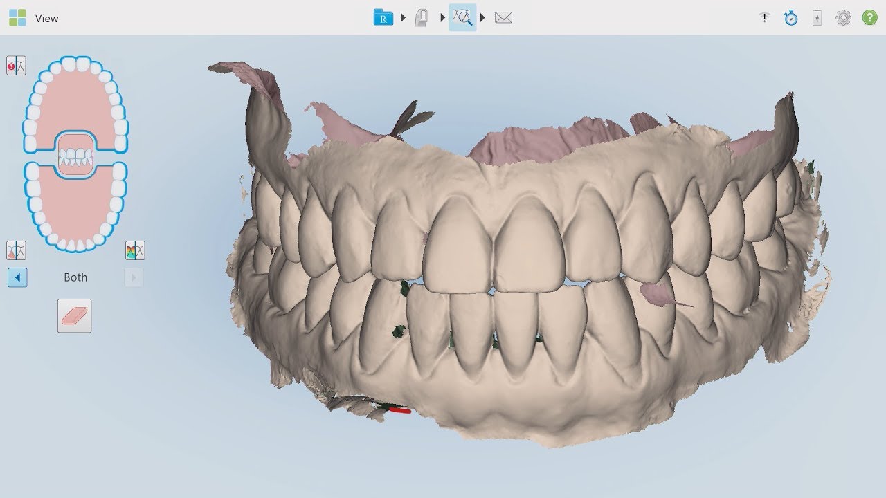 Chairside Live Episode 253: A Pre-Treatment Scan of the Upper Arch