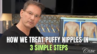 How to treat male puffy nipples   gynecomastia