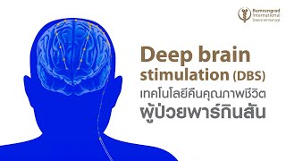 Deep brain stimulation (DBS) เทคโนโลยีคืนคุณภาพชีวิตผู้ป่วยพาร์กินสัน