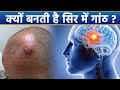 सिर में गांठ क्यों होती है सिर में गां�