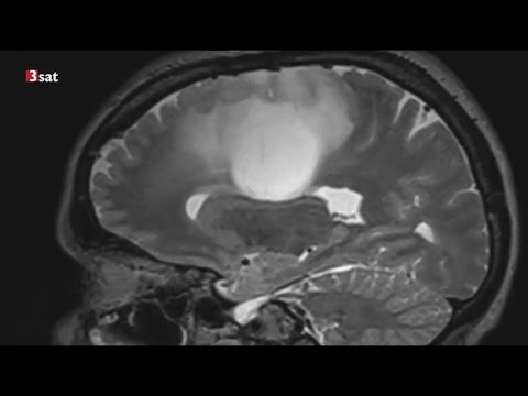 Methadon soll gegen Krebs helfen - weitere Forschung wird aber nicht finanziert (Nano 02.05.2017)
