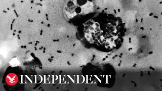 What is Strep A and what are the symptoms? What is Strep A and what are the symptoms?