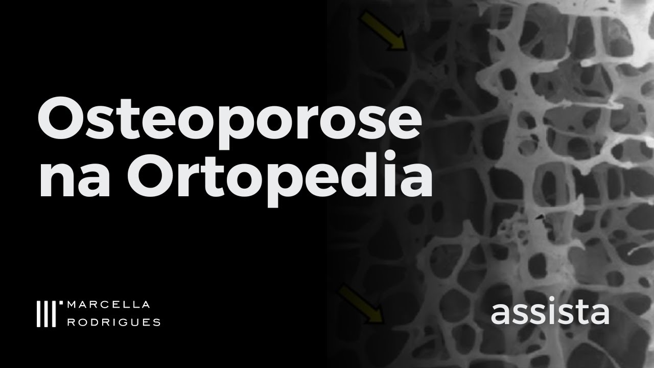 Osteoporose na Ortopedia