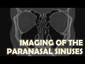 Imaging Anatomy of the Paranasal Sinuses