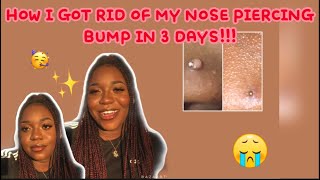 HOW I GOT RID OF MY NOSE PIERCING BUMP (KELOID) IN 3 DAYS!!! || with progress pictures #nosebump