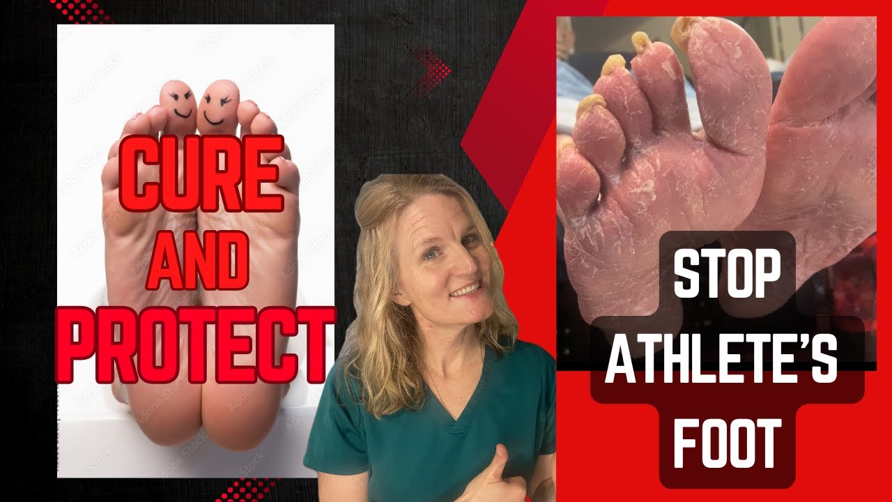 Stop Athlete's Foot: Podiatrist's 4 Proven Ways to Cure and Prevent it plus natural remedies!
