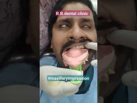 #maxillaryimpression#upperimpression#R.B.Dentalandimplantclinic#Dr.Antra😃👍