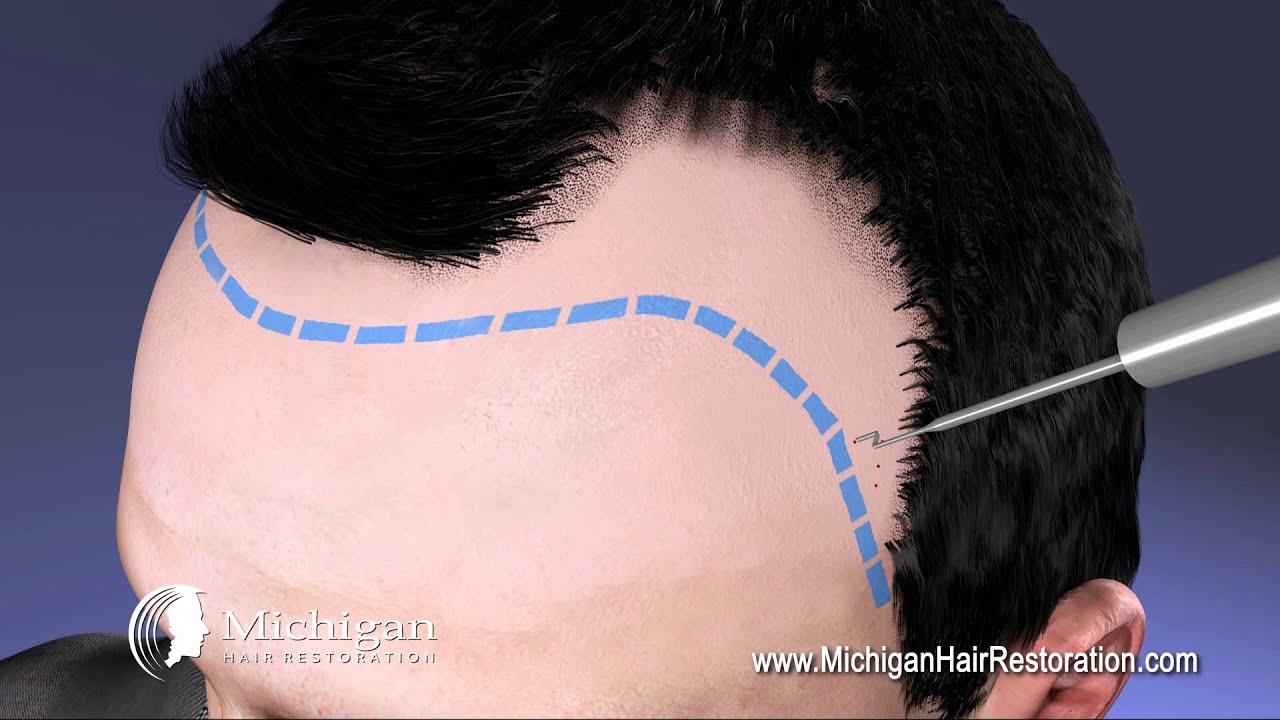 Hair Restoration Videos