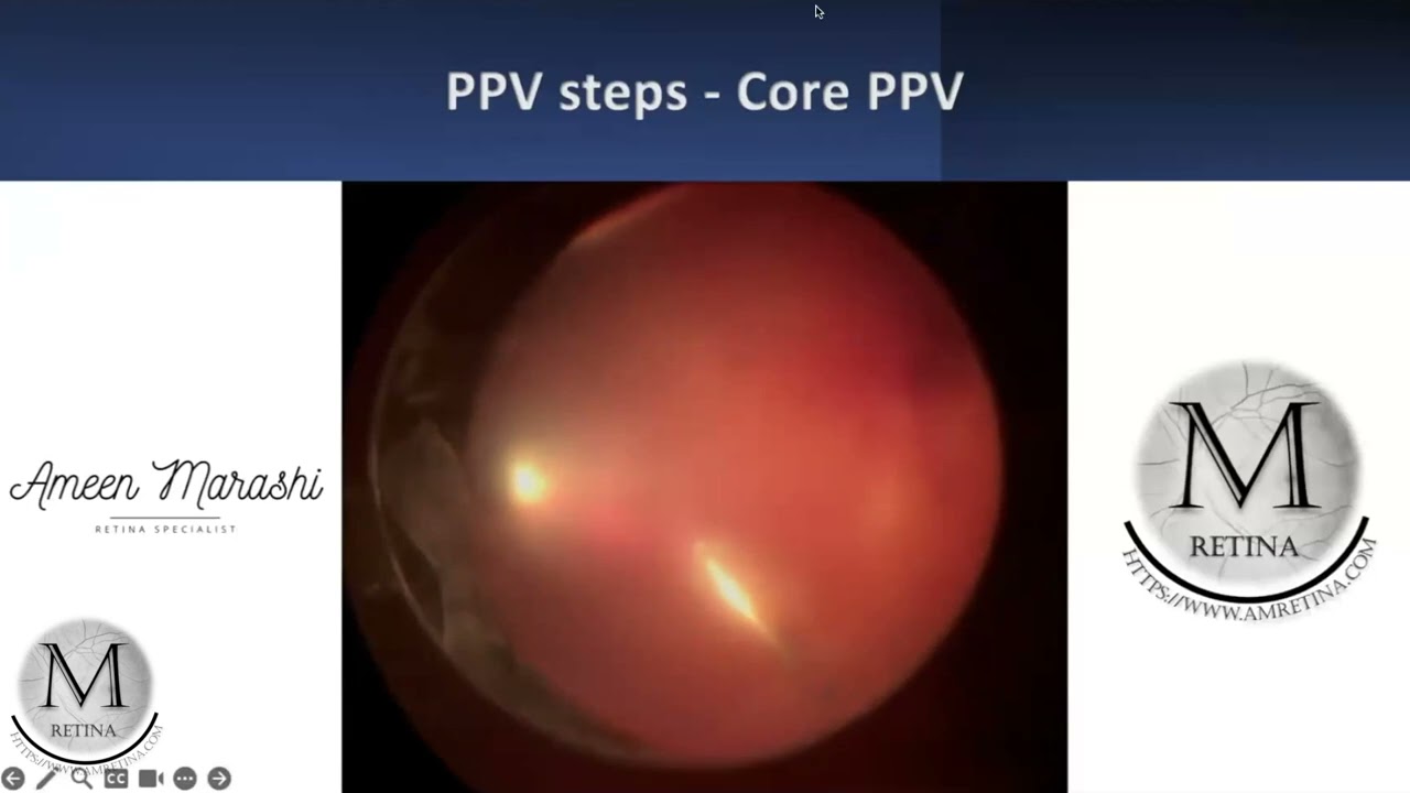 Surgical Management of Diabetic Vitreous Hemorrhage