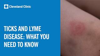 Ticks and Lyme Disease: What You Need To Know