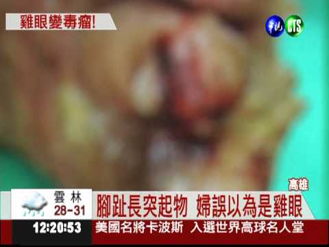 婦人腳底長疣 腳掌潰爛險罹癌