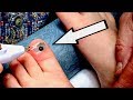 BURNING A HOLE THROUGH A TOENAIL (with blood trapped under it) | Dr. Paul
