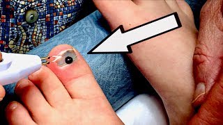 BURNING A HOLE THROUGH A TOENAIL (with blood trapped under it) | Dr. Paul