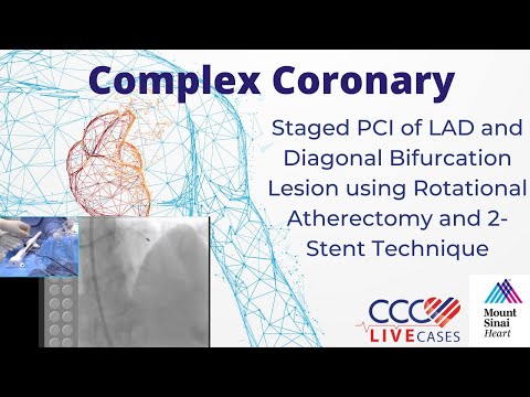 PCI of LAD & Diagonal Bifurcation Lesion using Rotational Atherectomy & 2-Stent Technique Feb 2016