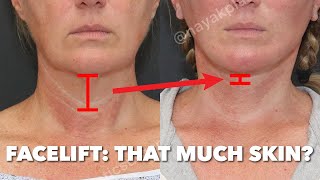 Her Skin Moved How Much With a Facelift???