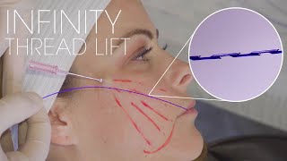 Infinity Thread Lift with Chin and Jawline Filler: Combination Therapies by Dr. Kian Karimi