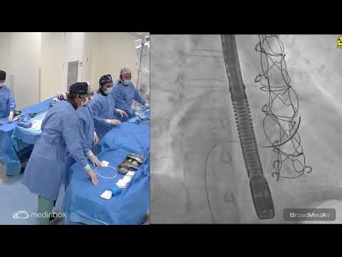 Transcatheter Tricuspid Valve Replacement