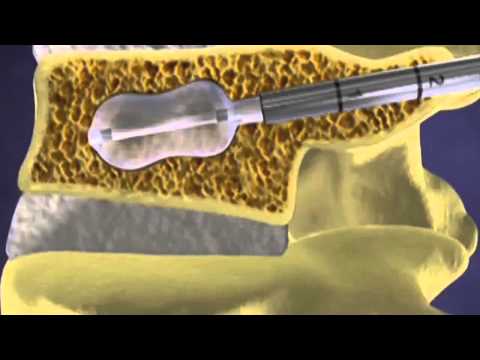 Fixing a Fractured Spine