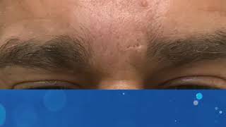 Tratamiento de las arrugas del entrecejo con Ácido Hialurónico