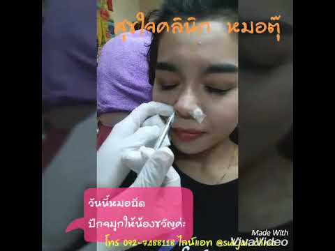 โบท็อก ปีกจมูก