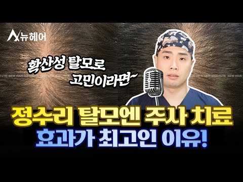 정수리 탈모에 모낭주사 추천하는 이유!ㅣ확산성 탈모ㅣ뉴헤어