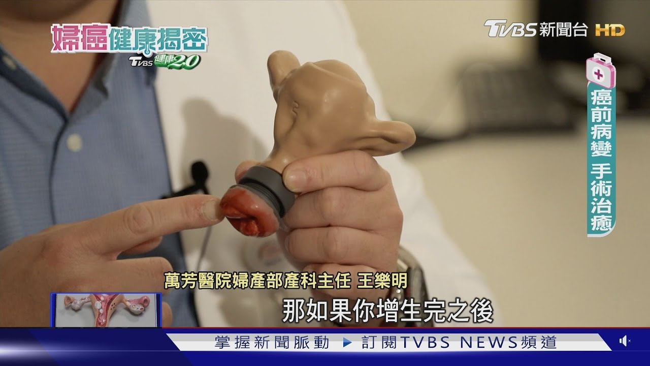 抹片檢查仍有偽陰性 防子宮頸癌可加做「這個」敏感度更高