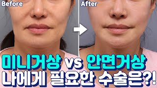 안면거상과 미니거상 중 어떤 수술이 적합할까? - 테일러성형외과
