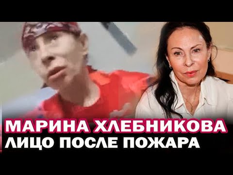 Марина Хлебникова впервые показала лицо после пожара. Как выглядит Хлебникова после пожара?