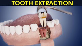 Tooth Extraction: Having a tooth pulled out Procedure