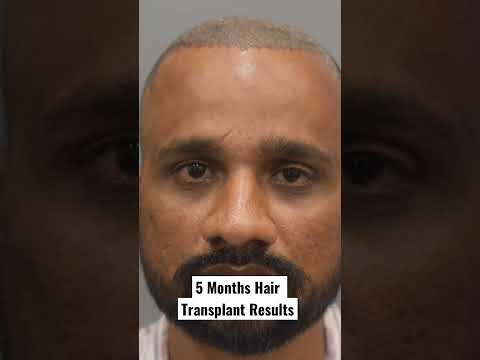 Hair Transplant Results Day 1 to Day 150 #shorts #hairtransplantinindia