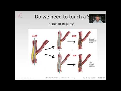 How to decide to treat or not to treat the side branch in Provisional stenting - Dr Marek LESIAK